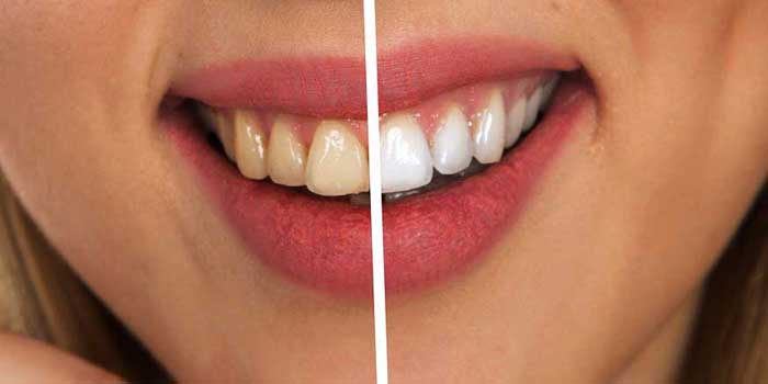 Dental Implant