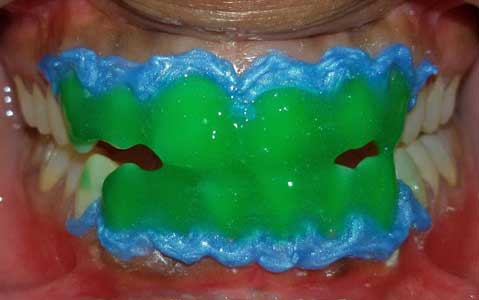 Infection in Wisdom Tooth